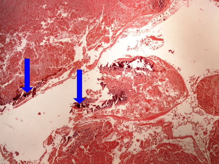 Z4-8 dystrophic calcification dystroficka kalcifikace 4x oznaceno.jpg