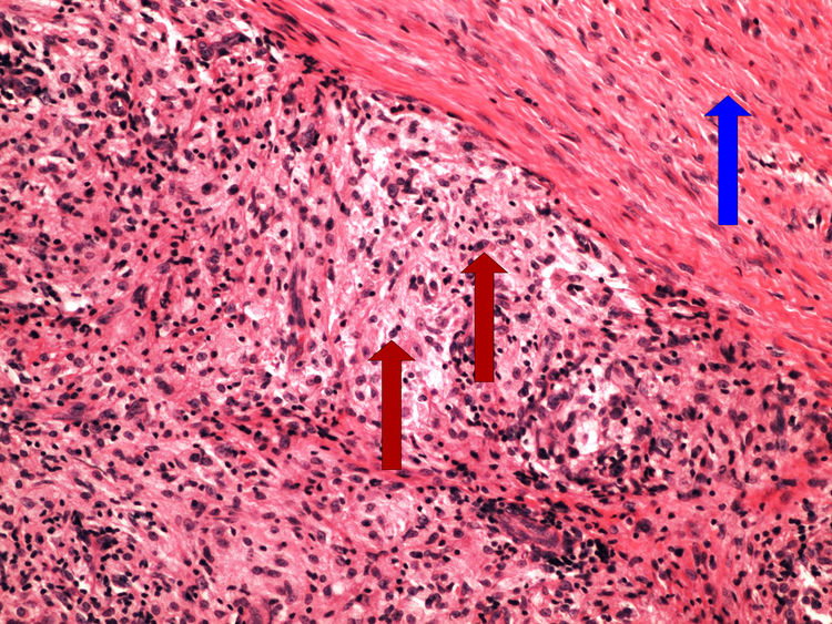 Z3-5 inflammatory pseudoxanthoma zanetlivy pseudoxantom 20x oznaceno.jpg