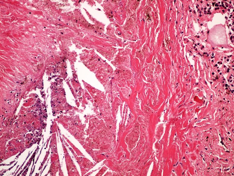 Silicosis silikoza 20x.jpg