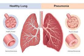 Pneumonia image.jpg