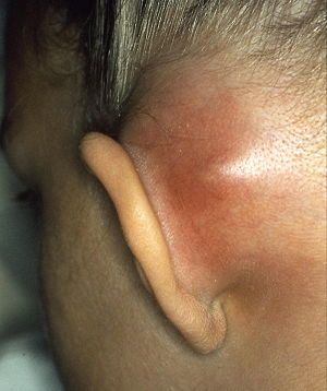 Subperiosteal abscess as a complication of mastoiditis