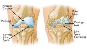 Arthritis of the knee.jpg
