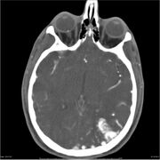 CT with contrast - AVM parietal lobe on the left