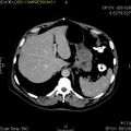 GIST in the stomach wall. CT with contrast.
