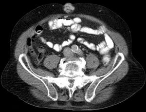 Caput medusae in pfortader high pressure in cirrhosis of the liver in computed tomography. (axial)