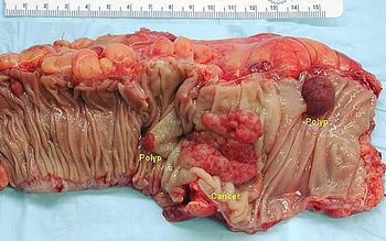 Colonic resection showing one exophytically growing carcinoma and two adenomatous polyps
