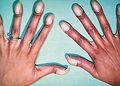Clubbed fingers in a patient with tetralogy of Fallot