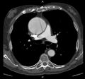 CT dissection of an aneurysmal ascending aorta