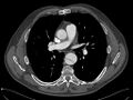 CT dissection of the descending aorta