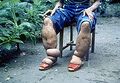 Feet swollen in elephantiasis