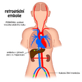 Retrograde embolism