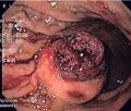 Endoscopic view of gastric GIST with surface ulceration.