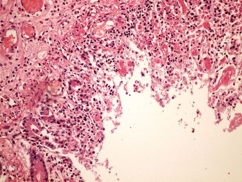 Hemorrhagic necrosis colon hemoragicka infarzace streva 20x.jpg