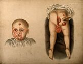 Manifestations of congenital syphilis.