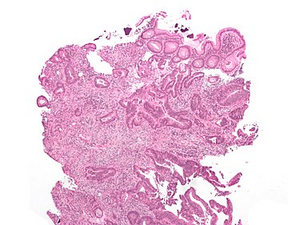 Histology: tubular adenocarcinoma, HE stained