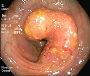 Sigmoid carcinoma, colonoscopy