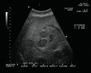 Sigmoid carcinoma, abdominal USG