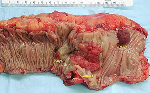 Colonic resection, visible one exophytically growing carcinoma and two adenomatous polyps