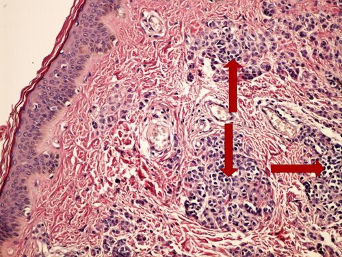 Intradermal mole intradermalni pigmentovy nevus 4x.jpg