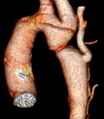 CT 3D reconstruction of aortic coarctation – detail