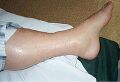 Leg swelling due to IL-11-induced capillary leak syndrome