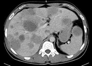 CT liver and spleen metastases