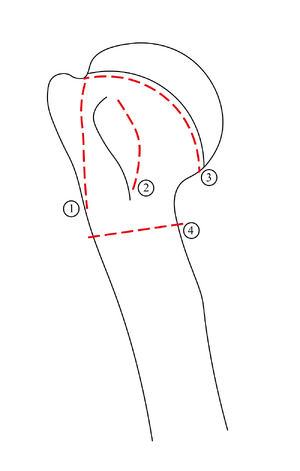 1. break-off of the greater tubercle 2. break-off of the lesser tubercle 3. anatomical neck 4. surgical neck