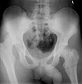 X-ray dorsocranial dislocation of the right hip