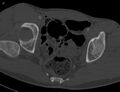 CT dorsocranial dislocation of the right hip