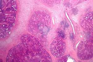Microscopic image of chronic sialoadenitis