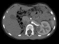 CT scan - nephroblastoma in a 4-year-old patient with a solitary double kidney