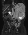 MRI image - neuroblastoma in the retroperitoneum in a 2-year-old patient.