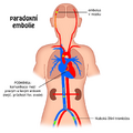 Paradoxical embolism
