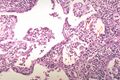 3. Non-granulomatous interstitial pneumonia/alveolitis. Arrows indicate small collections of macrophages. Early granuloma formation..