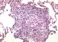 6. Non-granulomatous interstitial pneumonia/alveolitis. A poorly defined formation of macrophages and giant multinucleated cells. Growing granuloma.