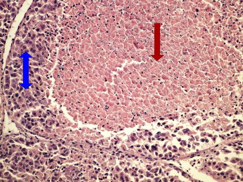 Z10-18 hepatocellular carcinoma 20x .jpg