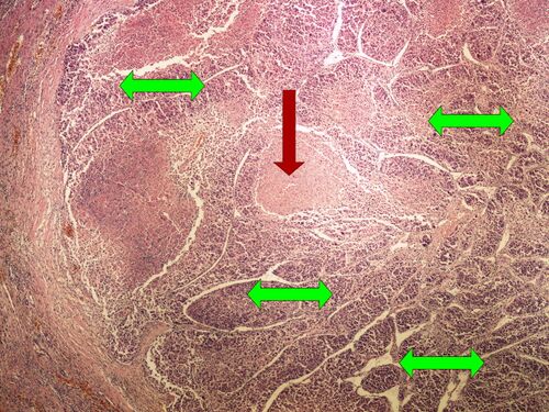 Z10-18 hepatocellular carcinoma 4x .jpg