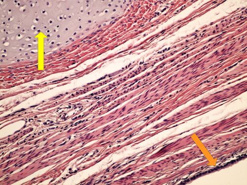 Z 11-11 teratoma ovary koetanni teratom ovaria 20x oznaceno.jpg